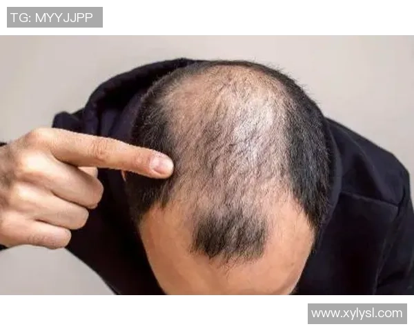 秃顶足球球星如何应对发量困扰与职业生涯的挑战